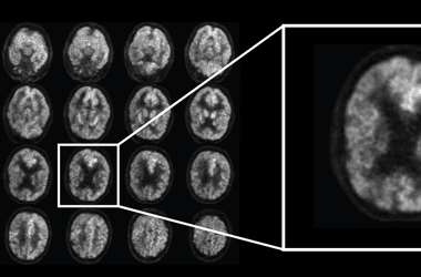 Lehet, hogy eddig rosszul tudták: nem biztos, hogy az agyban kell keresni az Alzheimer-kór okát
